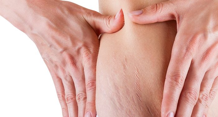 Perbedaan Stretchmark dan Selulit