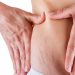 Perbedaan Stretchmark dan Selulit