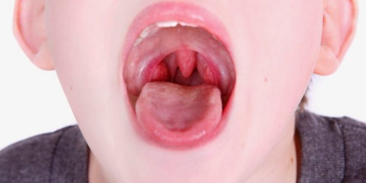 Amandel pada Anak, Apakah Perlu Dioperasi?