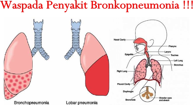 Penyakit Bronkopneumonia