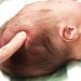 Benjolan Di Kepala Bayi Baru Lahir