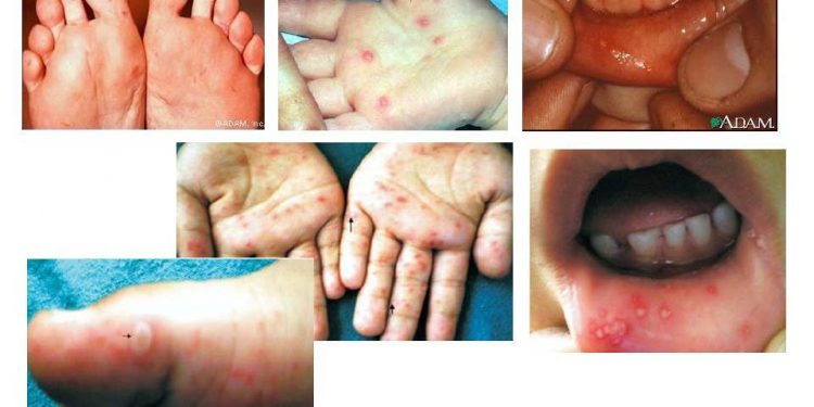 Penyakit Tangan, Kaki dan Mulut (Hand, Foot, and Mouth Disease – HFMD)