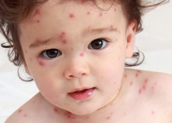 Waspada! Infeksi Virus yang Menular pada Anak!