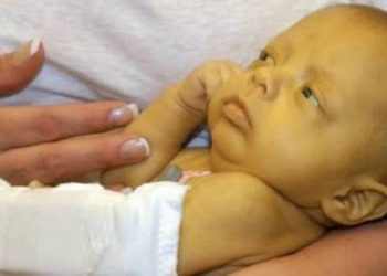 Apa Sih Penyakit Kuning? Yuk Simak Penjelasannya!