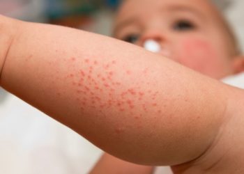 Scabies & Cacing Kremi, Masalah Kulit yang Sering Terjadi Pada Anak!