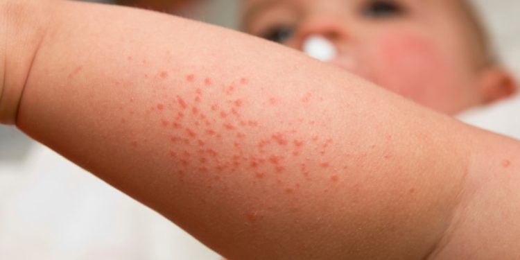 Scabies & Cacing Kremi, Masalah Kulit yang Sering Terjadi Pada Anak!