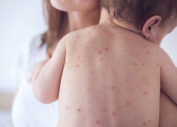 Campak Jerman / Rubella