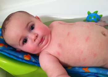 Cara Mengatasi Biang Keringat pada Bayi dengan Aman & Ampuh!