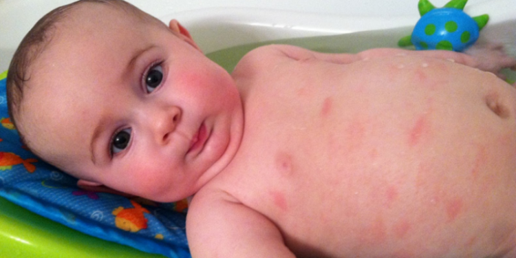 Cara Mengatasi Biang Keringat pada Bayi dengan Aman & Ampuh!