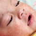 Pentingkah Imunisasi MR Bagi Si Kecil?
