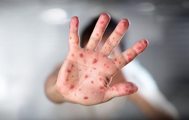 Penyakit Measles