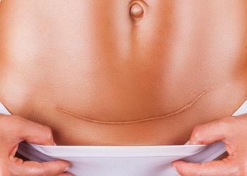 Perawatan Luka di Masa Nifas Setelah Melahirkan