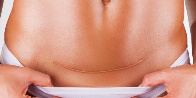 Perawatan Luka di Masa Nifas Setelah Melahirkan