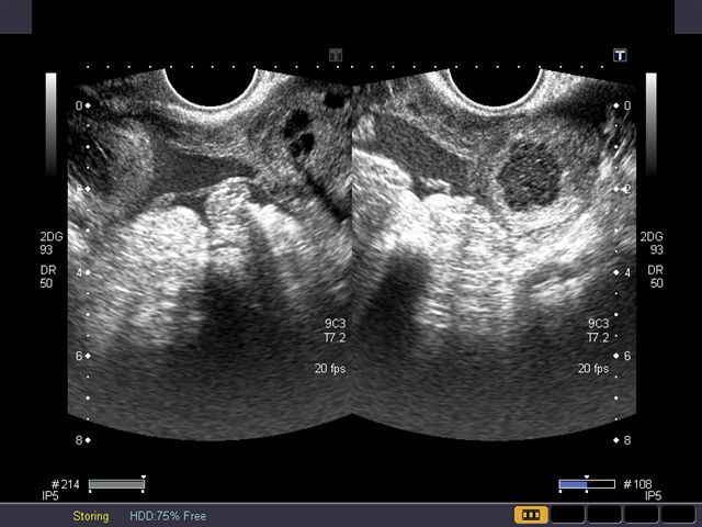 Kehamilan Dengan Kista Ovarium Sumber: obgyn.net