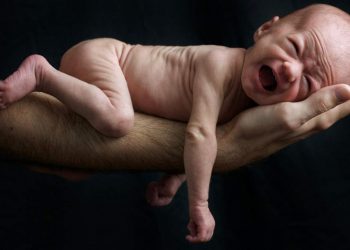 Cari Tahu Penyebab Stunting Anak, Agar Segera Bisa Diatasi!