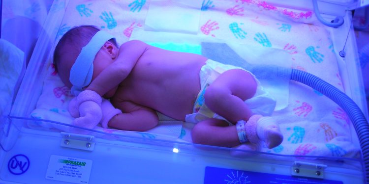 penanganan breast milk jaundice bayi kuning karena asi