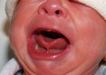 Kenali Gejala Tongue Tie Bayi yang Patut Diwaspadai!