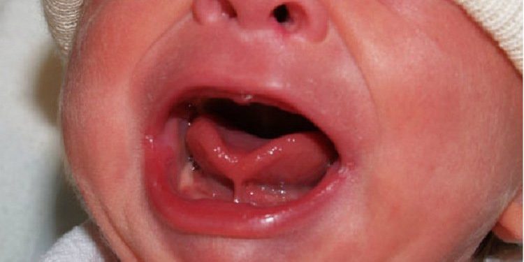 Kenali Gejala Tongue Tie Bayi yang Patut Diwaspadai!