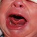Kenali Gejala Tongue Tie Bayi yang Patut Diwaspadai!
