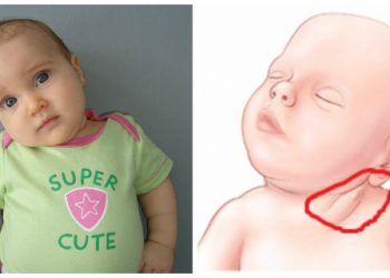 Kepala Bayi Miring Ke Satu Sisi? Kenali Mengenai Tortikolis!