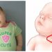 Kepala Bayi Miring Ke Satu Sisi? Kenali Mengenai Tortikolis!