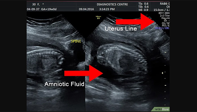 Identifikasi rahim pada USG