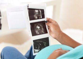 Cara Mempersiapkan Kelahiran Bayi Sungsang Secara Alami