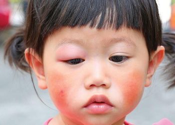 Mampaps Penting Ketahui Penyakit Lupus Pada Anak