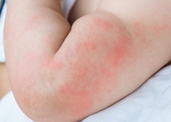 Biduran pada Bayi, Ketahui Lebih Lanjut yuk, Mams!