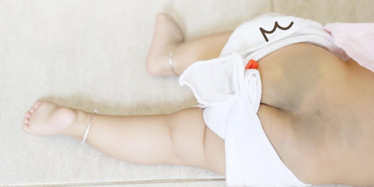 Tanda Lahir Biru pada Bayi Bisakah Menghilang?