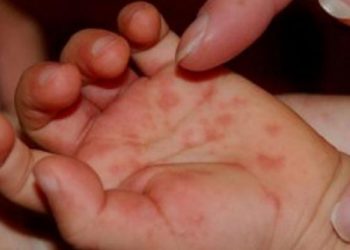 Anak Terkena Flu Singapura, Apa yang Harus Dilakukan?