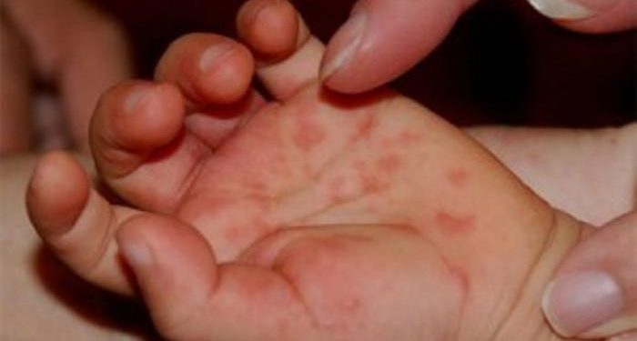 Anak Terkena Flu Singapura, Apa yang Harus Dilakukan?