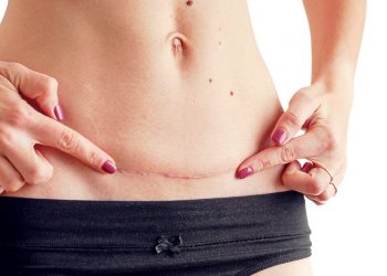 Luka Keloid Pasca Operasi Caesar Mengganggu? Hilangkan Yuk, Mams!