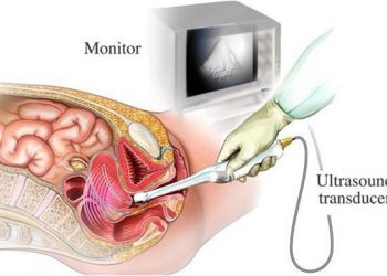 Ma, Perlukah Melakukan USG Transvaginal Saat Promil?