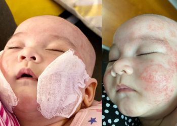 Dermatitis Atopik, Sederet Anak Artis Ini Pernah Mengalaminya