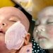 Dermatitis Atopik, Sederet Anak Artis Ini Pernah Mengalaminya