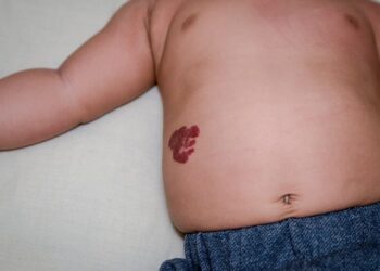 Mams ketahui Penyakit Hemangioma Pada Anak
