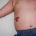 Mams ketahui Penyakit Hemangioma Pada Anak
