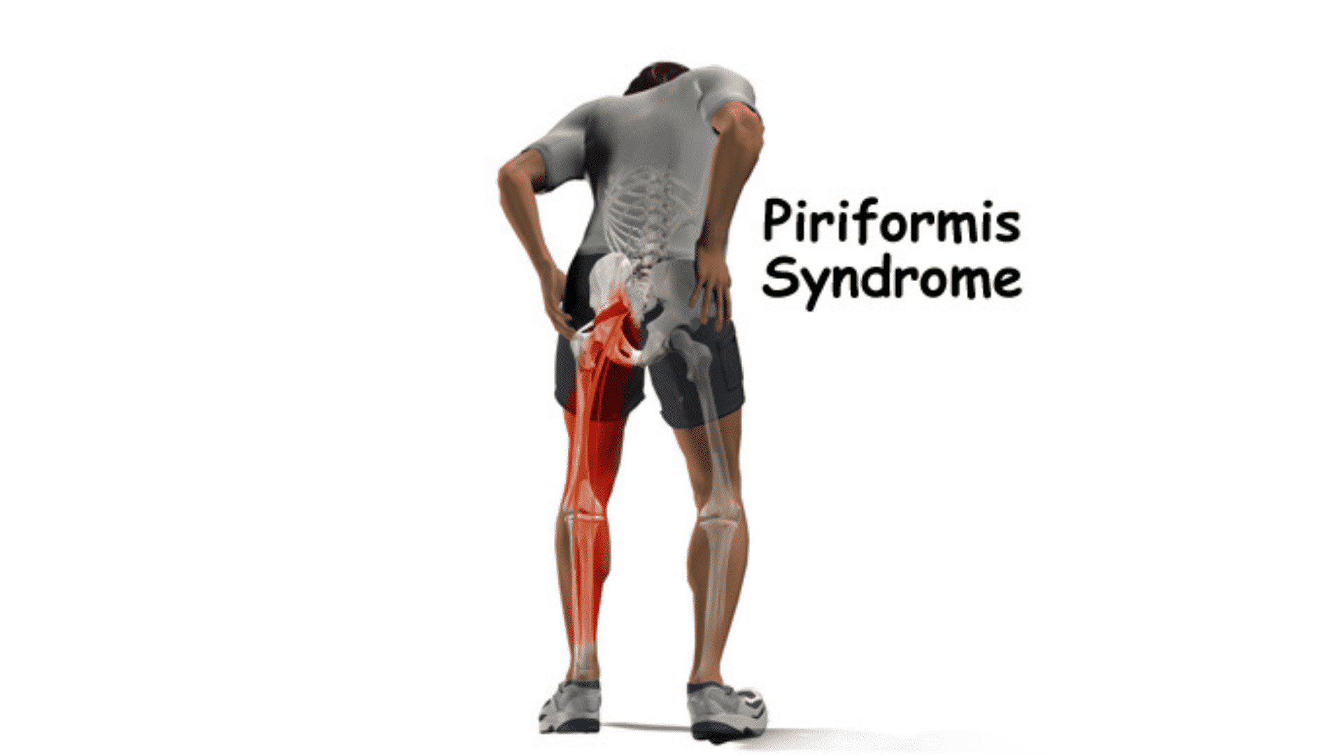piriformis syndrome
