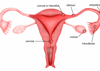 Kehamilan Ektopik: Penyebab, Gejala, dan Pengobatan