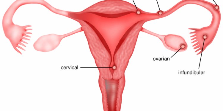 Kehamilan Ektopik: Penyebab, Gejala, dan Pengobatan